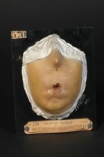 Lupus tuberculeux cicatrisé ; atrésie de la bouche et des narines