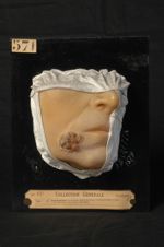 Trichophytie du menton, forme sycosique