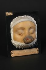 Lupus ulcéreux végétant du nez ; ectropion cicatriciel de l'œil droit (V. le n° 649, même malade que [...]
