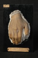 Trichophytie généralisée ; lésions des ongles ; onychomycosis