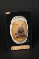 Lupus tuberculo-gommeux de la face. Lupus malin, galopant, aigu, tuberculo-ulcéreux, rongeant en sur [...]