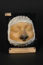 Lupus tuberculo-gommeux de la face (V. le n° 595, même malade après deux mois et demi de traitement)