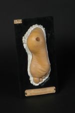 Gomme syphilitique ulcérée du talon, simulant un mal perforant