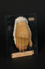 Sclérodermie progressive, avec lésions ulcéreuses et bourgeonnantes des phalanges. Homme âgé de 44 a [...]