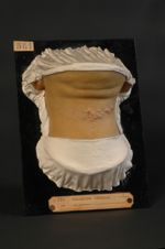 Acné chéloïdienne de la nuque, première période