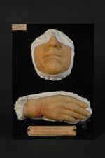 Chéloïdes cicatricielles dn menton et de la main, suite de brûlure