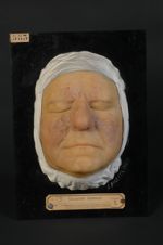 Acné rosée ; forme télangiectasique, hypertrophique, variété cohérente. La pièce montre une maculati [...]