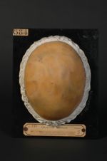 Favus du cuir chevelu ; aspect général. Favus ancien à toutes les périodes ; îlots sains, élevés ; c [...]