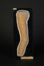 Psoriasis ; poussée aiguë