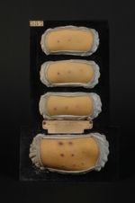 Ecthyma. 1° Auto-inoculations de pustules d'ecthyma simple (deuxième, troisième et quatrième jour)