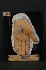 Eczéma kératosique et fissuraire (Inv. 1922) de la paume de la main