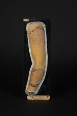 Lupus tuberculo-gommeux serpigineux du bras