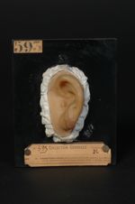 Lupus tuberculeux angiomateux de l'oreille gauche, très affaissé par la compression du moulage