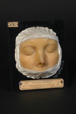 Lupus tuberculo-gommeux du nez, après traitement (V. le n° 577, même malade deux mois et demi aupara [...]