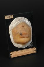 Corne de la lèvre supérieure, sur cicatrice de lupus ; récidive