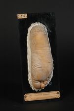 Ichtyose congénitale ; lésion de la plante du pied droit