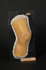 Télangiectasie généralisée. Femme âgée de 45 ans (V. le n° 611, pied de la même malade)