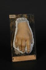 Psoriasis avec arthropathies. Noter les lésions périunguéales et les sillons transversaux des ongles [...]