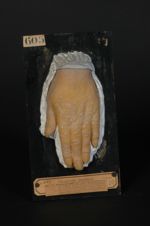 Psoriasis des ongles. Pièce à étudier à la loupe. C'est à tort que l'on a indiqué les formes exclusi [...]