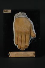 Eczéma des ongles. Pièce d'étude à examiner à la loupe. La lésion est limitée absolument aux ongles  [...]