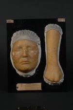 Favus généralisé. Face et avant-bras. Femme âgée de 20 ans, domestique