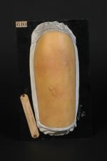 Erythème polymorphe de la cuisse. Femme âgée de 53 ans