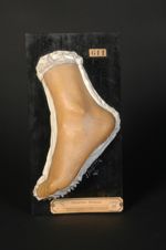 Télangiectasie généralisée. Femme âgée de 45 ans (V. le n° 599, genou de la même malade)