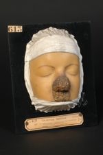 Lupus ulcéreux et végétant du nez (Inv. 1889). Jeune fille âgée de 16 ans