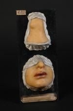 Erythème polymorphe (Inv. 1922). Erythème hydroïque sur le poignet ; hydroa des lèvres