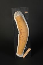 Pustules vaccinales confluentes, après vaccination sur une surface eczémateuse