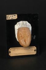 Glossite syphilitique tertiaire ; forme scléreuse