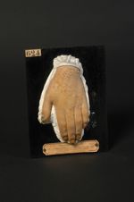 Dermite artificielle chronique, à forme d'eczéma vésiculeux, chez un garçon limonadier âgé de 18 ans [...]