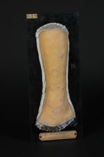 Lichen plan annulaire, prurigineux (moulage décoloré, Inv. 1922)