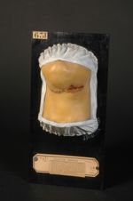 Lésions mixtes de la syphilis et de la scrofulo-tuberculose ; adénopathie suppurée et ulcérée de la  [...]