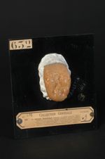 Glossite syphilitique scléreuse nodulaire profonde. Saillies papillaires nombreuses ; fissures multi [...]