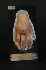 Erythème pernio ; phlegmon hypodermique du dos de la main droite chez un jeune sujet de 15 ans 1/2,  [...]