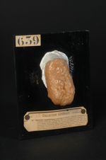 Glossite syphilitique scléreuse profonde. Lésions cirrhotiques, nodules scléreux ; l'affection date  [...]