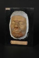 Plaques syphilitiques végétantes du menton ; condylomes plats des auteurs allemands (Inv. 1922). Syp [...]