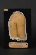 Favus généralisé, chez un enfant âgé de 6 ans