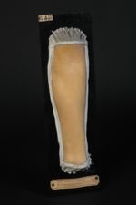 Lichen plan lichénifié de l'avant-bras (Inv. 1922). Lichen ruber acuminatus