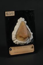 Acné rosée ; couperose variqueuse de la face