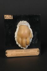 Périostite syphilitique gommeuse de la main. Enfant