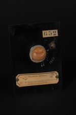 Erosion limitée du col utérin (Inv. 1922). Eczéma du col utérin