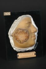 Lupus tuberculo-ulcéreux de la joue droite