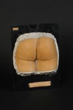 Xanthome plan (V. les n° 654 et 655, coude, genou et main du même malade)