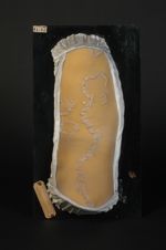 Psoriasis figuré, psoriasis rubané, psoriasis gyrata