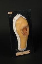 Gommes syphilitiques ulcérées de la région scapulaire, ayant détruit en partie le muscle deltoïde