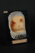 Ecthyma térébrant, de cause indéterminée. Enfant