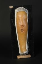 Gomme syphilitique ulcérée du mollet