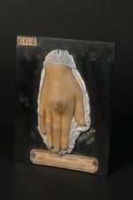 Gomme scrofulo-tuberculeuse de la main